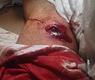 اصابة بالقدم خلال مظاهرات صباح الناصر